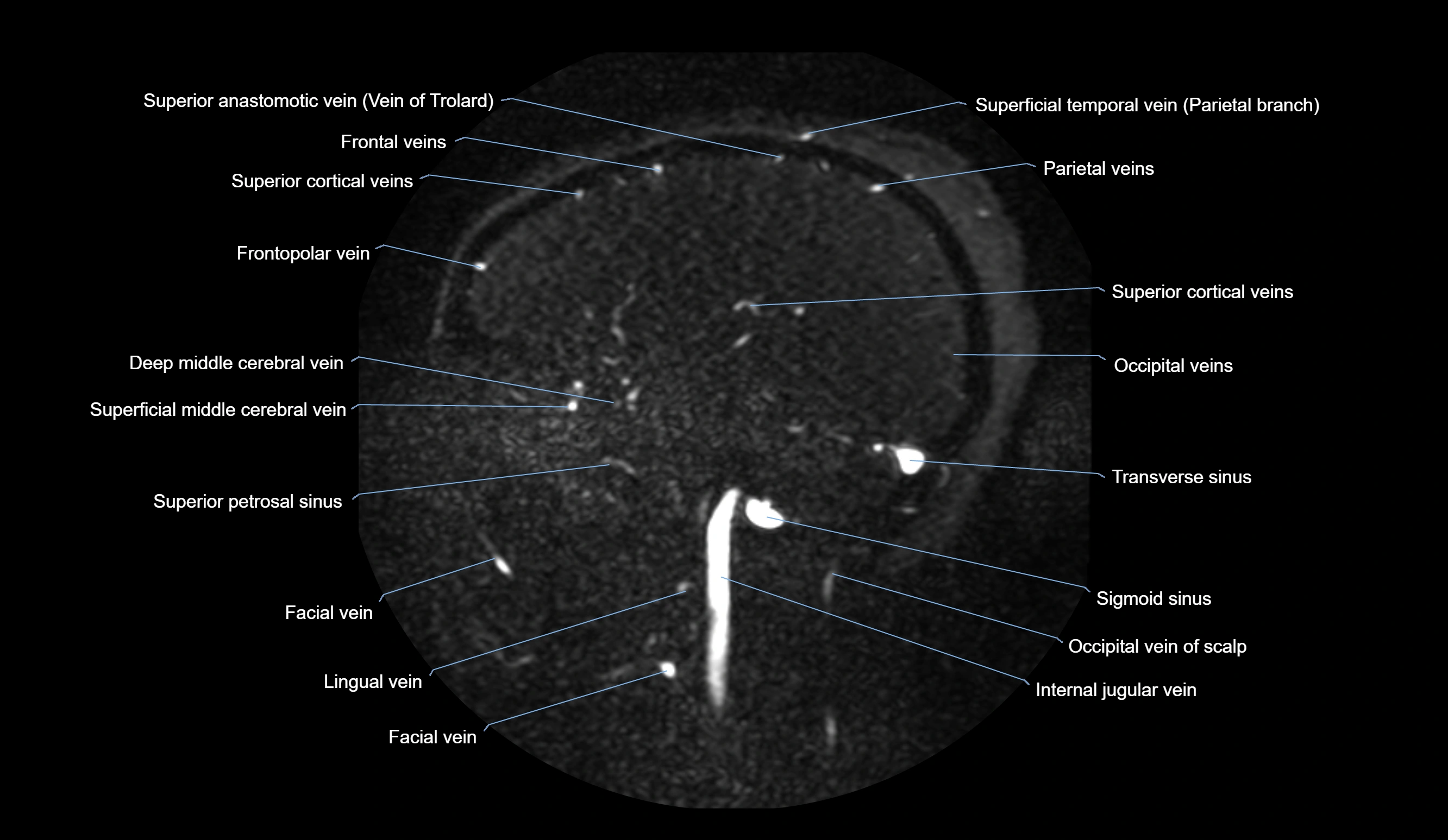 MRV brain sagittal anatomy 3T MRI images -img-01015-00026.webp